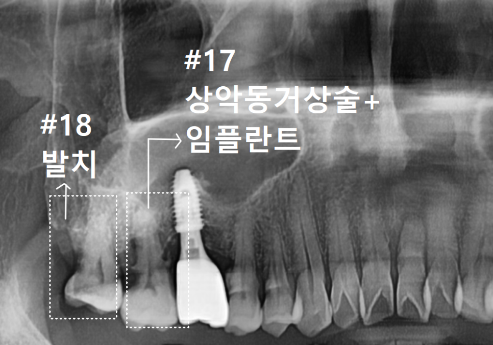 고덕동 어금니 브릿지 교체, 관련 이미지 12