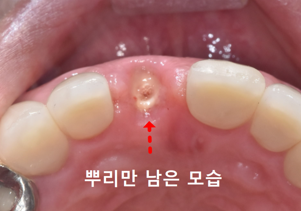 고덕동 앞니 보철, 브릿지와 싱글 크라운, 어떤 선택이 나에게 더 유리할까? 관련 이미지 13