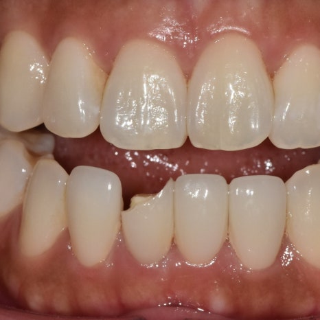 No-Prep Veneers: Do They Really Involve No Tooth Shaving? The 3 Questions Patients Ask Most image 1