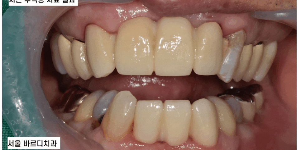 입 마름 치근 우식증이 쉽게 생길 수 있습니다!! 관련 이미지 1