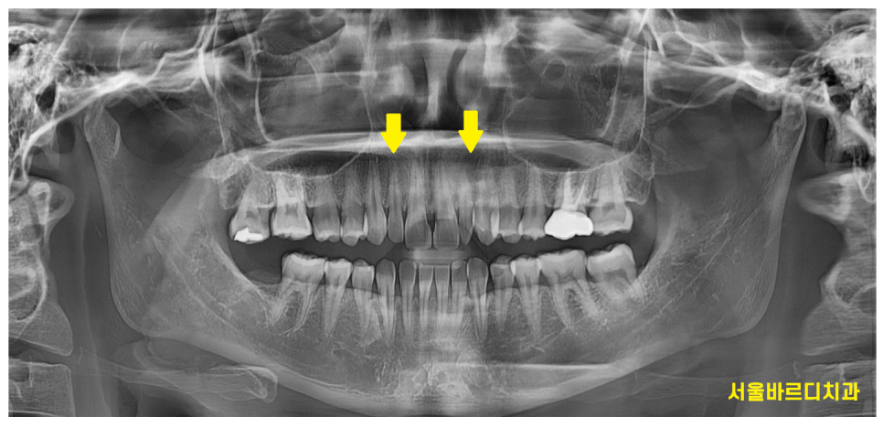 왜소치 라미네이트 작은 치아 콤플렉스 말끔하게 극복해요!! 관련 이미지 3