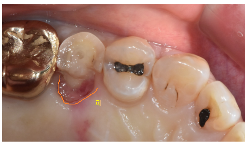 상일동역 임플란트 구강스캐너로 디지털 진료 선두하는 대표 치과입니다! 관련 이미지 4
