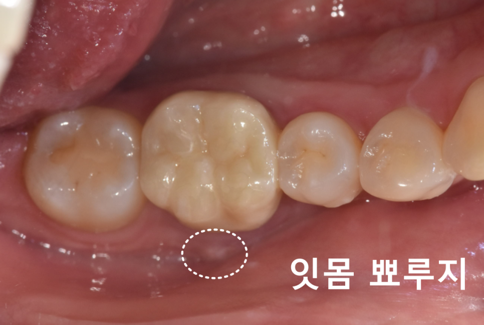 고덕동 20대 임플란트, 시기 놓치면 비용 2배 이상 듭니다. 관련 이미지 4