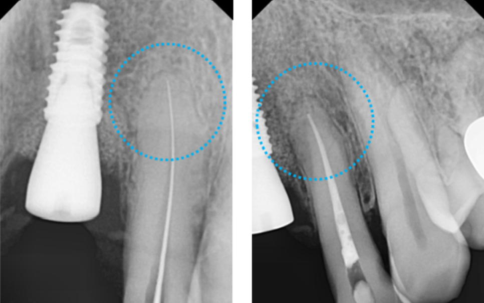 고덕동치과 서울바르디치과 전치부 및 구치부 임플란트 치료증례 #9 관련 이미지 8