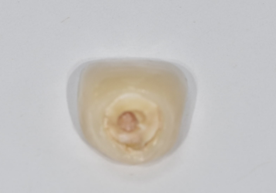 고덕동 앞니 보철, 브릿지와 싱글 크라운, 어떤 선택이 나에게 더 유리할까? 관련 이미지 12