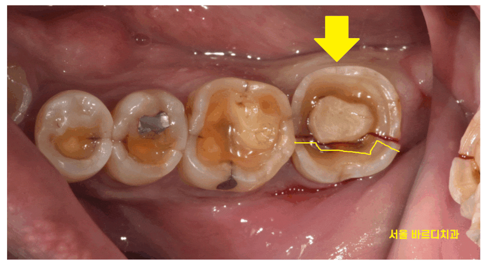 망월동 치과 신경치료 후 보철 꼭 씌워야 하나요?? 관련 이미지 1
