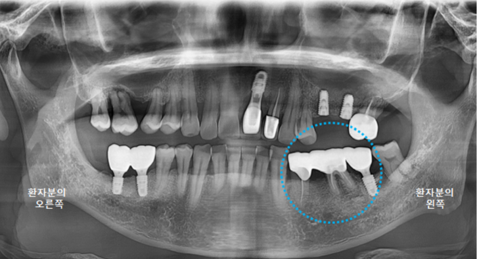 고덕동치과 서울바르디치과 전치부 및 구치부 임플란트 치료증례 #9 관련 이미지 30