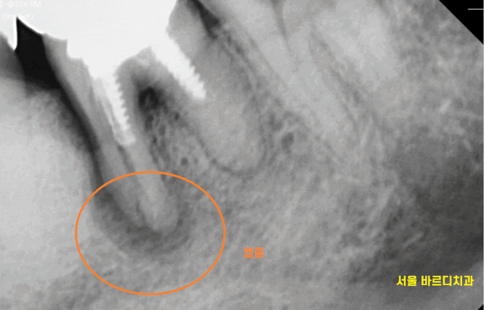 고덕역 치과 치아뿌리 파절 부러짐 있을 때 임플란트로 대체해야죠 관련 이미지 1