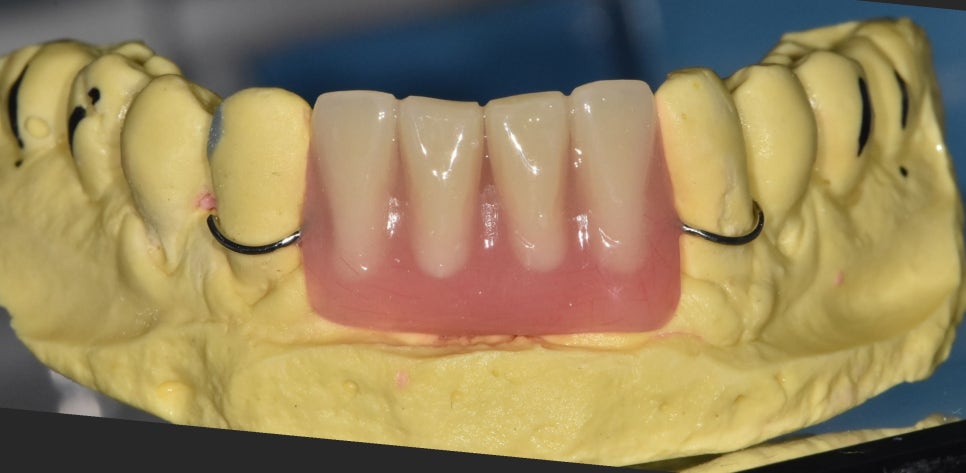 대문니 빠짐, 앞니 빠졌을 때 브릿지와 임플란트 중 나에게 맞는 선택은? 관련 이미지 10