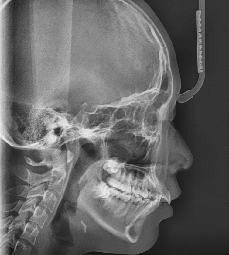 상일동 치아 교정 고려해봐야할 2가지 요소 관련 이미지 1