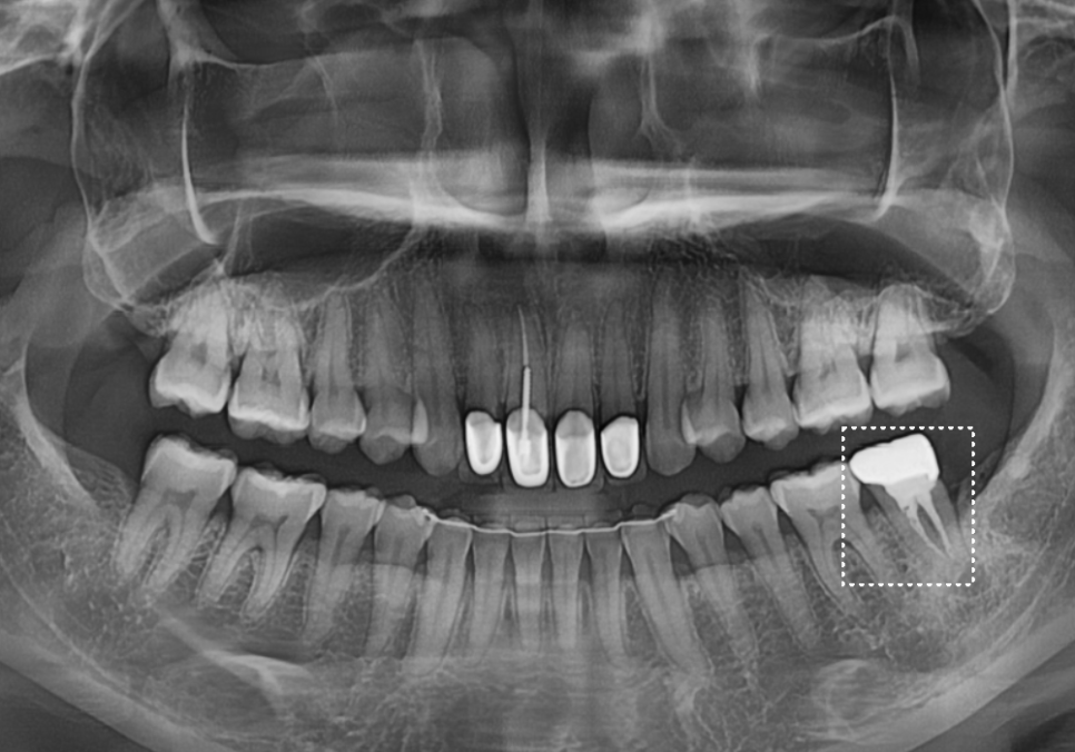 강동구 치아 뿌리 염증, 신경치료 한 치아인데도 아플 수 있나요? 관련 이미지 5