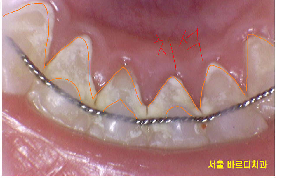 치과 유지장치 떨어짐 언제까지 하고 있어야하나요? 관련 이미지 3