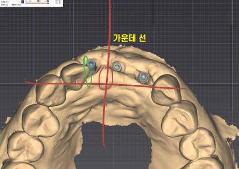상일동역 치과 윗니 앞니 흔들림 임플란트로 심미까지 잡았습니다. 관련 이미지 11