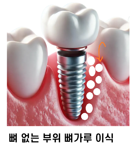 강일동 임플란트 뼈이식재 종류는 뭔가요? 안전성이 걱정되신다면 필독 관련 이미지 1
