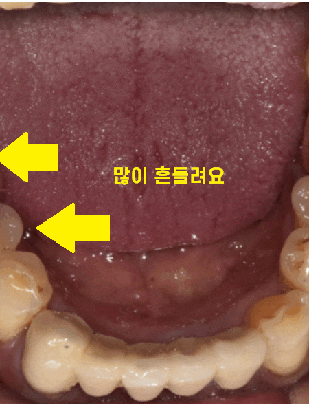 하남시청치과 치아 욱신거림 임플란트로 치료해드렸습니다. 관련 이미지 1