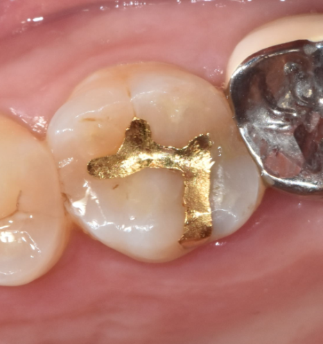 치아 땜질 다 떼울 수는 없지만..강동구 치과에서는 이렇게 합니다. 관련 이미지 3