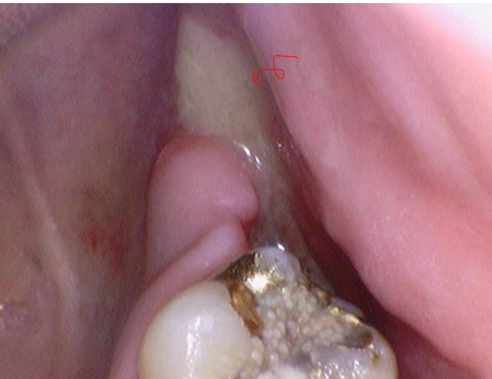 Is It Difficult to Shorten the Implant Procedure Period? Why It Differs from Person to Person image 6