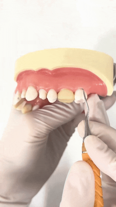 잇몸 주저앉음 발치하게 되는 제일 큰 원인이기에 잇몸치료 과정 공개 관련 이미지 1