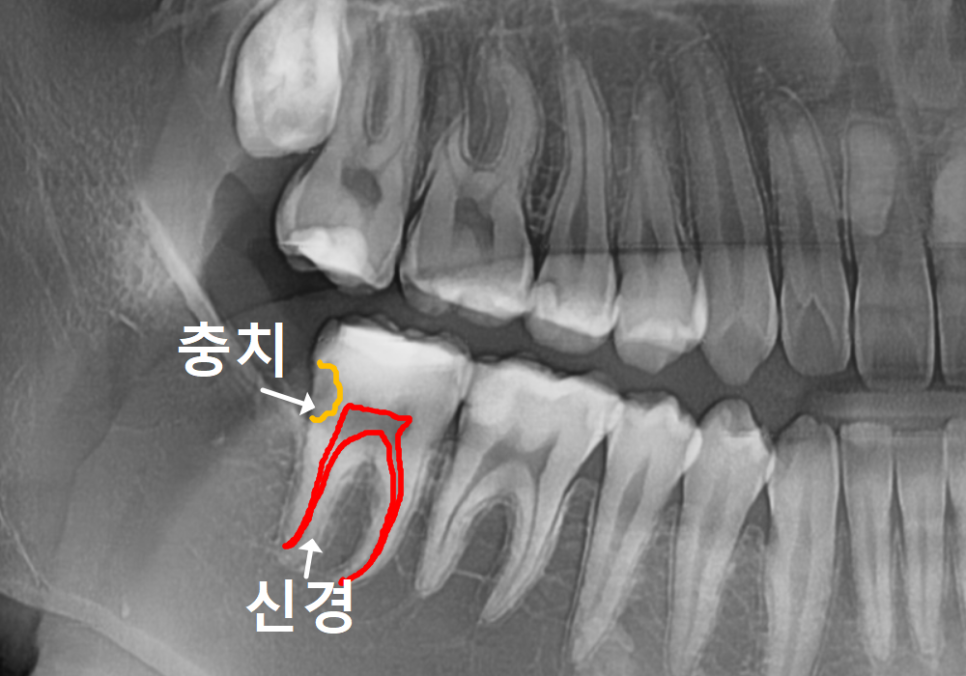 고덕동 사랑니 매복 발치, 안 아픈데 꼭 빼야 하나요? 관련 이미지 13