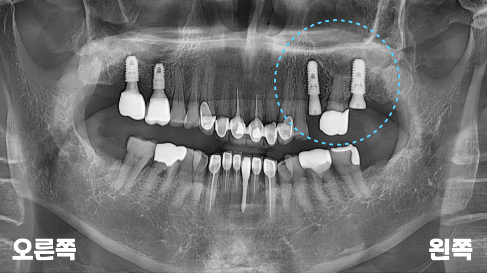 서울바르디치과 뿌리 끝 염증 심한 치아를 네비게이션 임플란트 #6 관련 이미지 12
