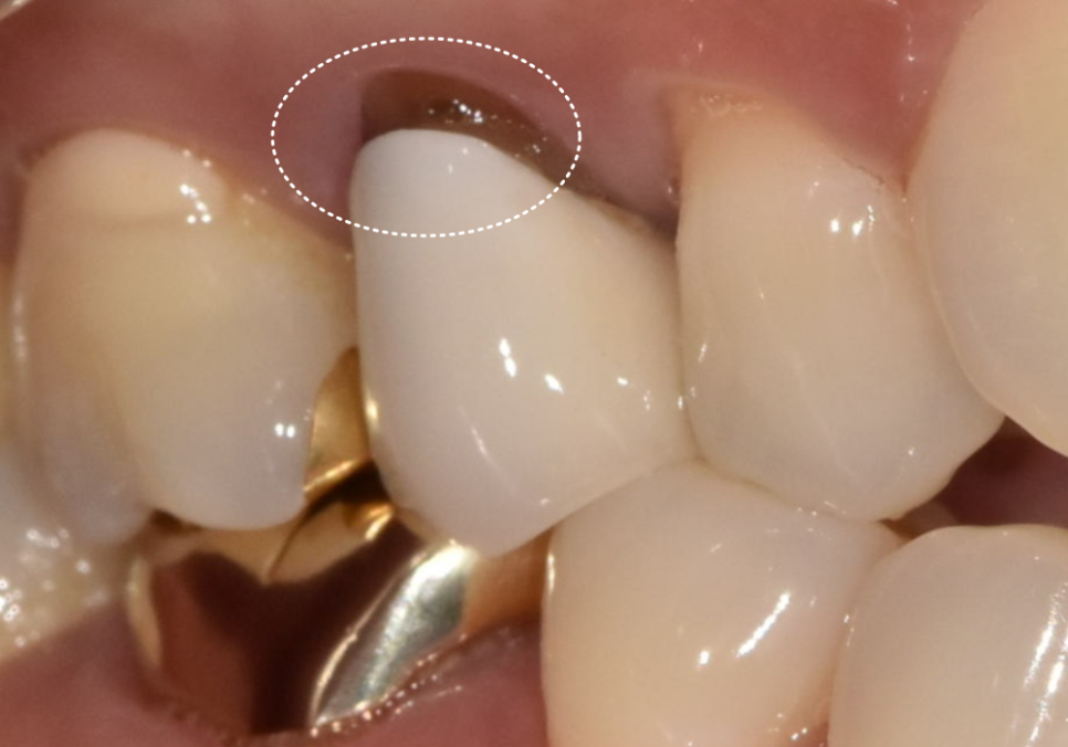 앞니 라미네이트 교체, 재시술 전 꼭 알아야 할 실패를 줄이는 방법 관련 이미지 2