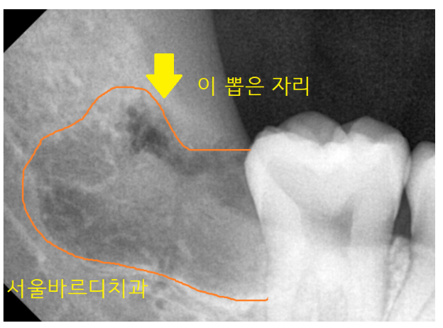 강동구 사랑니 묻혀있는 매복치아 꼼짝마!!! 뽑아줄테니까 관련 이미지 7