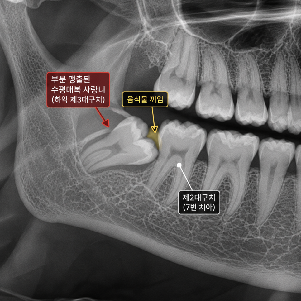 상일동 옆으로 누운 수평 매복 사랑니, 멀쩡한 앞어금니까지 썩게 합니다 관련 이미지 3
