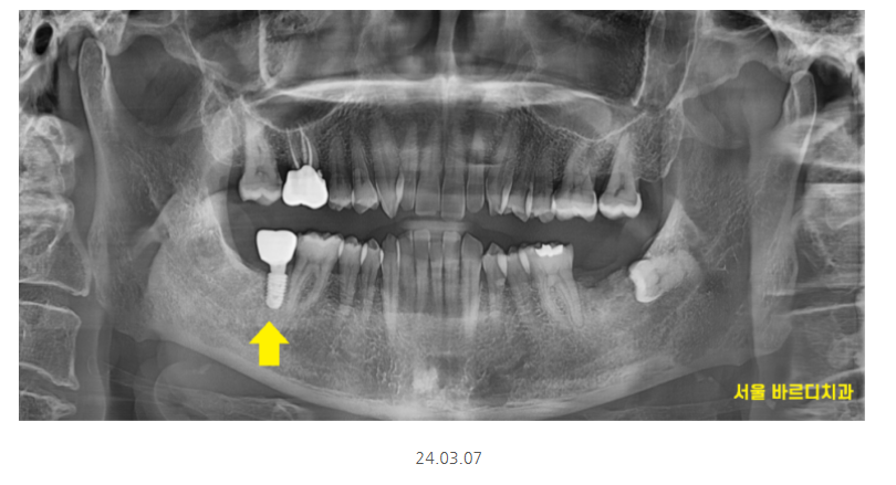 하남시청치과 내비게이션 임플란트 뭐가 좋아요?? 관련 이미지 9
