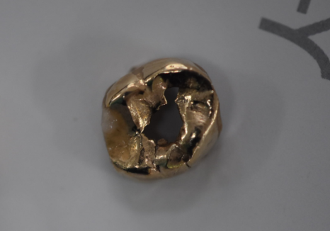 상일역 치과, 오래된 금니 빠짐, 같은 증상으로 내원했지만 전혀 다른 결과, 그 차이는? 관련 이미지 18