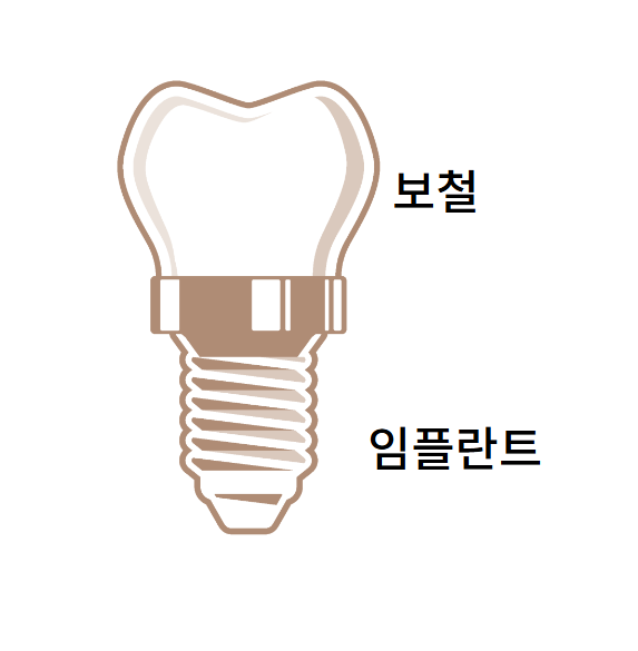 천호동 치과 임플란트 크라운 종류 설명 나갑니다. 관련 이미지 2
