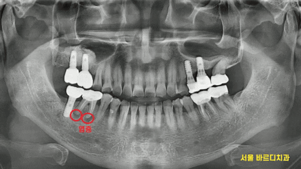 미사역 임플란트 잇몸이 풍선처럼 부풀어오르는 치주농양 환자분 관련 이미지 1
