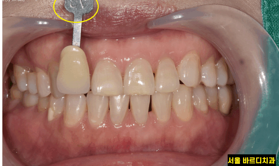 상일동 치아 미백 결혼 전 받아야하는 이유 3가지 관련 이미지 1