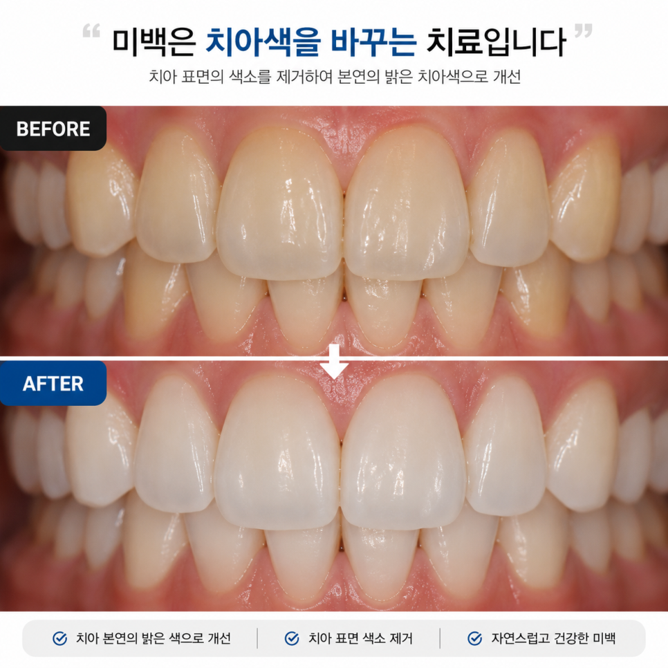 Some Discoloration Cannot Be Resolved with Whitening (Whitening vs. Veneers) image 1