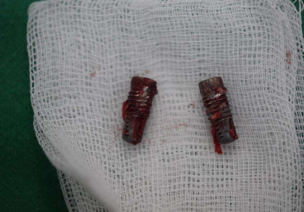 오래된 임플란트, 흔들림과 통증, 어떻게 하면 더 건강하게 쓸 수 있을까? 관련 이미지 8