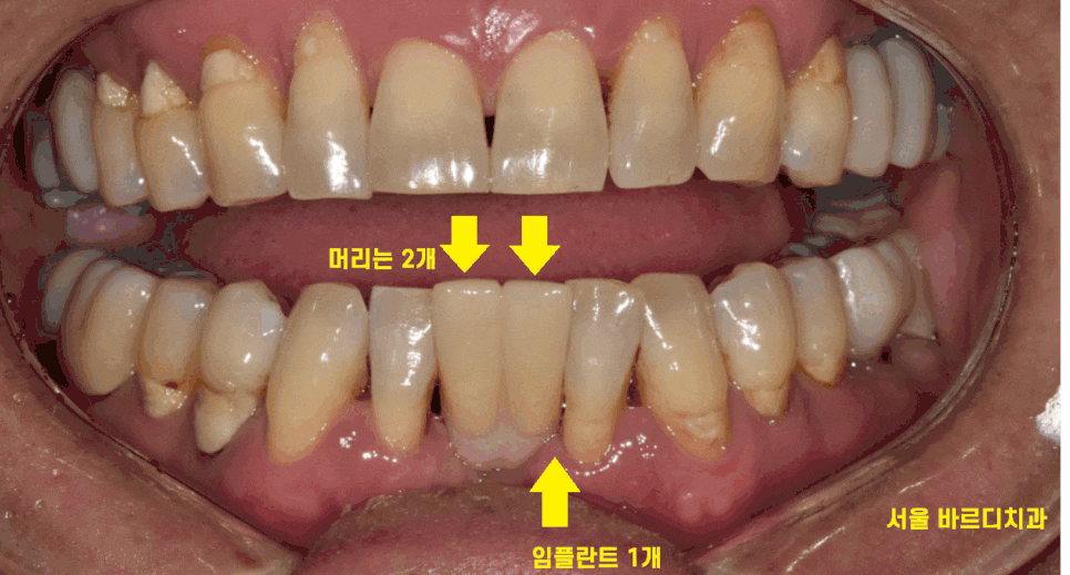 둔촌동 치과 아래 앞니 임플란트 뼈가 없을 때 일체형으로! 관련 이미지 1
