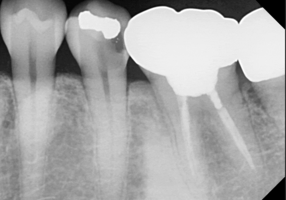아말감 파절, 조금 깨졌을 뿐인데, 2차 충치로 치아 절반이 깨진 사연 관련 이미지 5