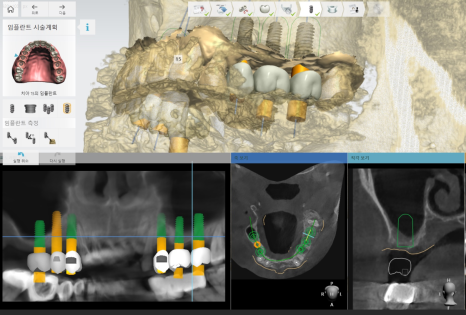 고덕동 치과 뼈이식 동반 양쪽 어금니 임플란트 동시 진행 관련 이미지 6