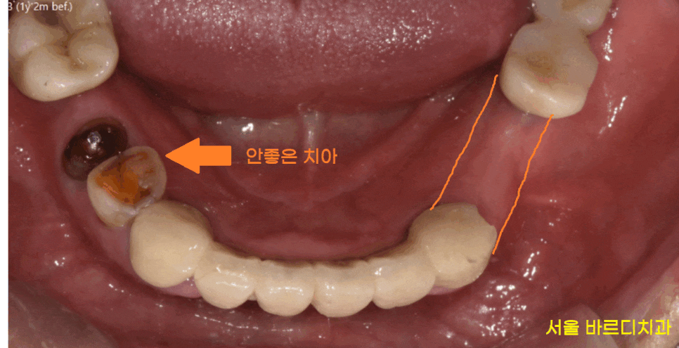 명일동 치과 임플란트 치료 기간 얼마나 걸릴까요??? 관련 이미지 1
