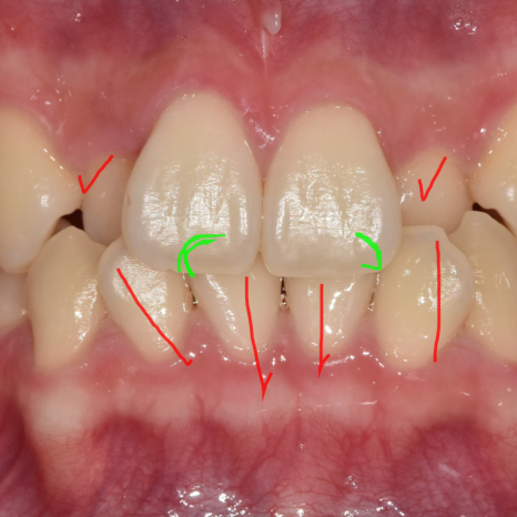 Sangil-dong Orthodontic Dentist: Do Protruding Front Teeth Really Need Orthodontic Treatment? image 8