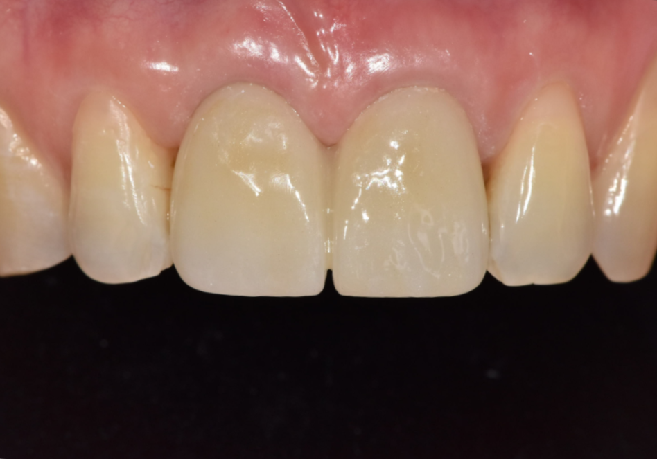 잇몸 까매짐 원인,증상,치료 방법 오래전에 앞니 씌운 곳 잇몸이 까매졌어요. 관련 이미지 15