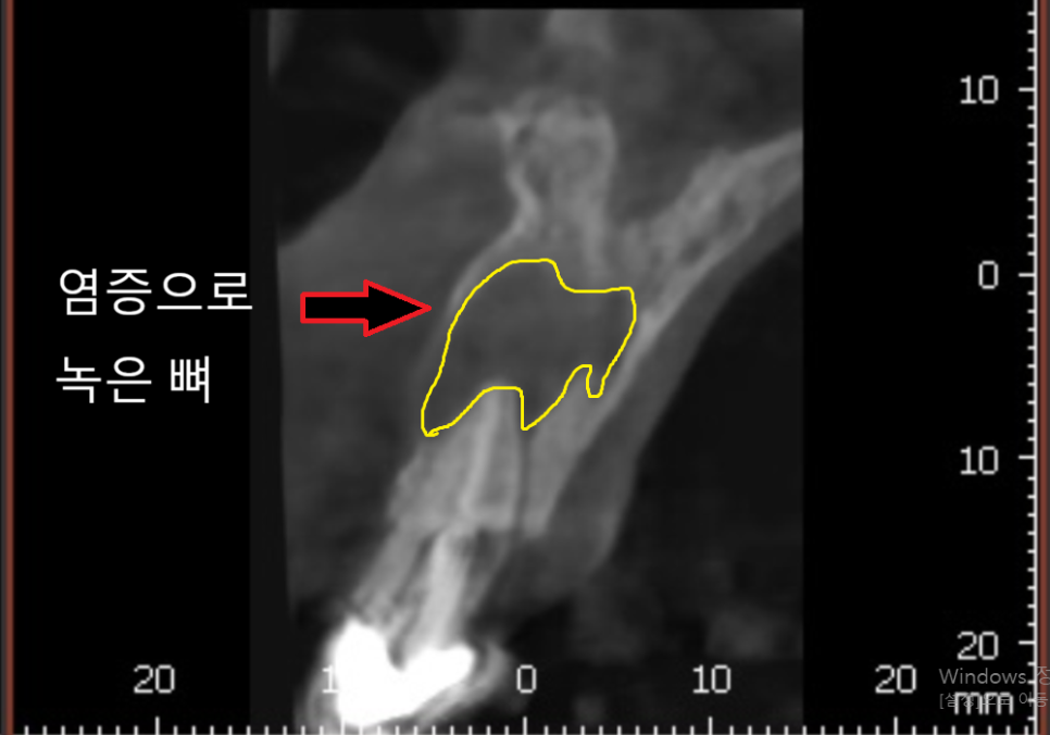 어금니 염증, 자연치 살리기에 진심인 저는 이렇게 살렸습니다. 관련 이미지 3