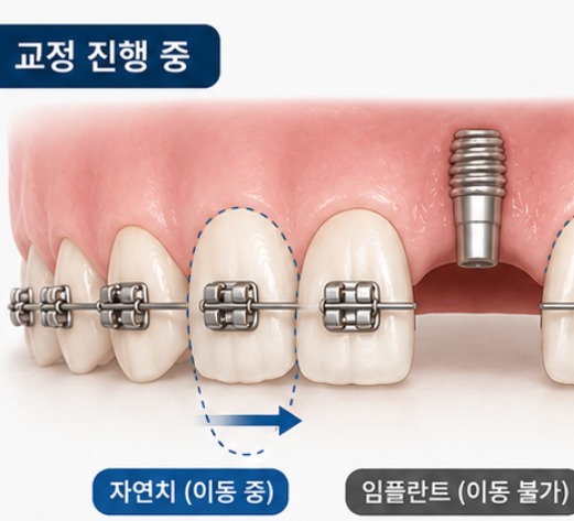 치아 교정 치료, 임플란트 둘 중 뭘 먼저 해야 되나요? 관련 이미지 1