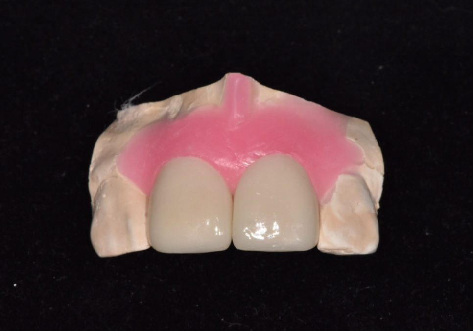 강일역 치과, 검게 보이는 앞니 레진 변색, 무조건 새로 해야 할까요? 관련 이미지 10