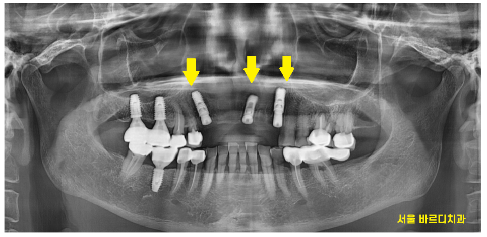 하남미사치과 앞니 브릿지를 임플란트로 교체했습니다. 관련 이미지 6