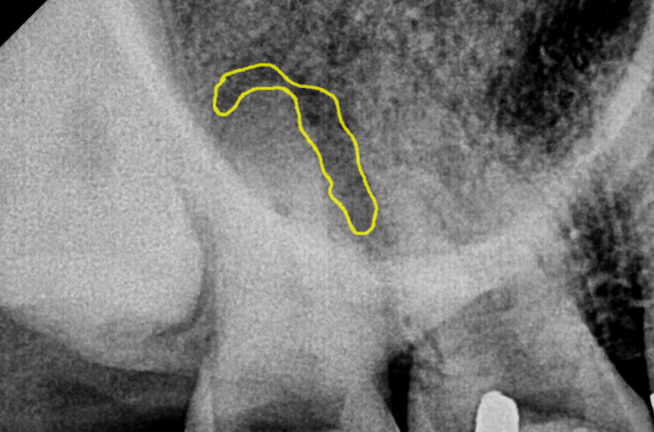 치아 뿌리 염증 빼야 된다는 치아, 이렇게 살렸습니다. 치료 방법 관련 이미지 5