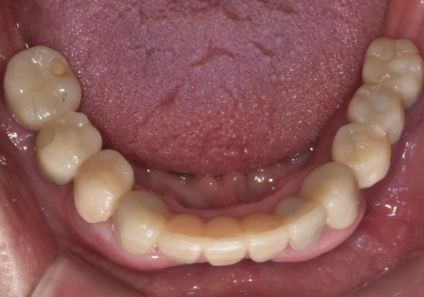 뿌리만 남은 치아, 그대로 두면 왜 위험할까요? 고덕동 전체 임플란트 재건 사례 관련 이미지 18