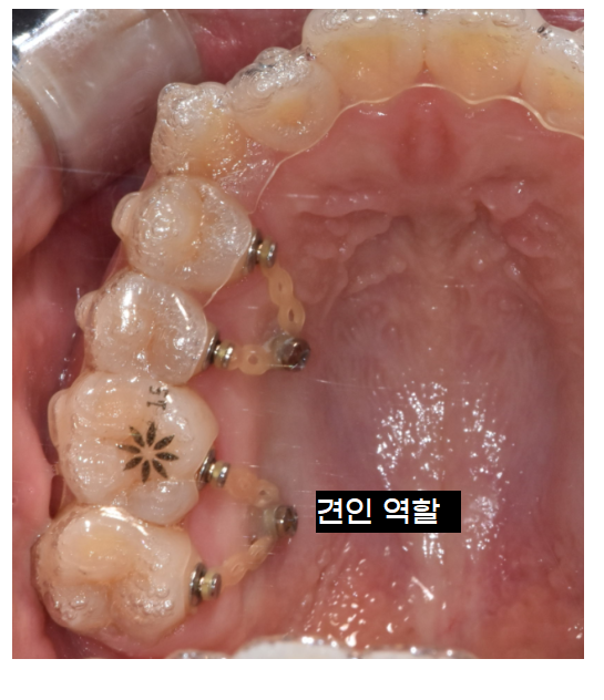 천호동 교정치과 치아교정 고무줄 왜 끼는건가요? 관련 이미지 5