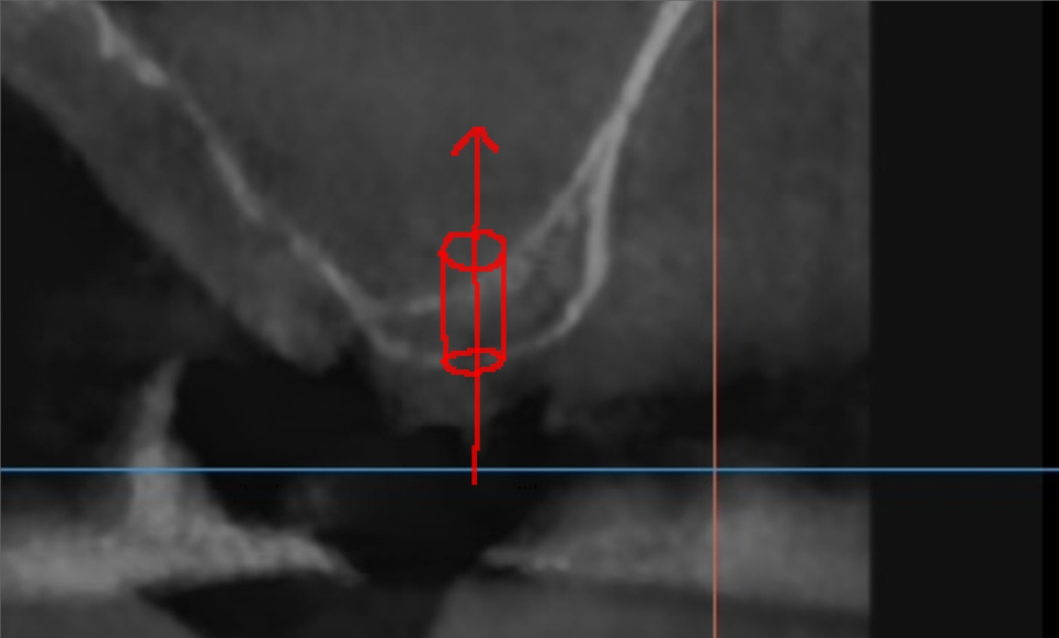 상일동 임플란트 상악동 거상술을 동반한 수술 증례 관련 이미지 6