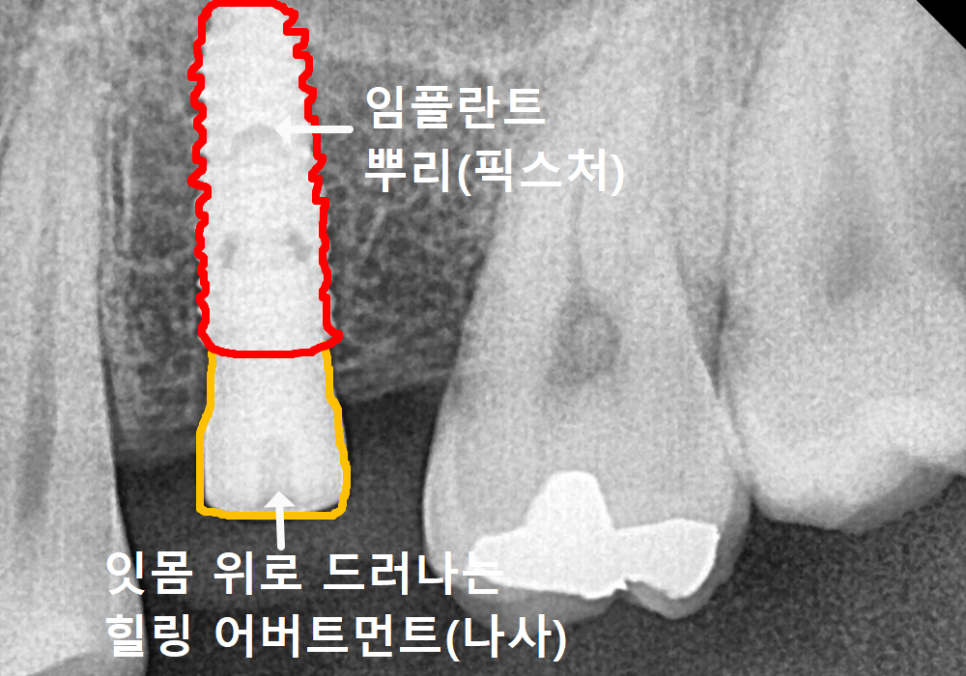 Sangil-dong Station Implant Visits: How Many Times Do You Actually Need to Go to the Dentist? image 3