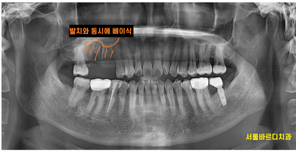 하남시청치과 신경치료 치아 발치 후 임플란트 했습니다. 관련 이미지 5